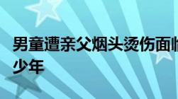 男童遭亲父烟头烫伤面临截肢虐待最高能判多少年