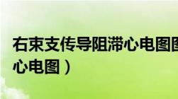 右束支传导阻滞心电图图形（右束支传导阻滞心电图）